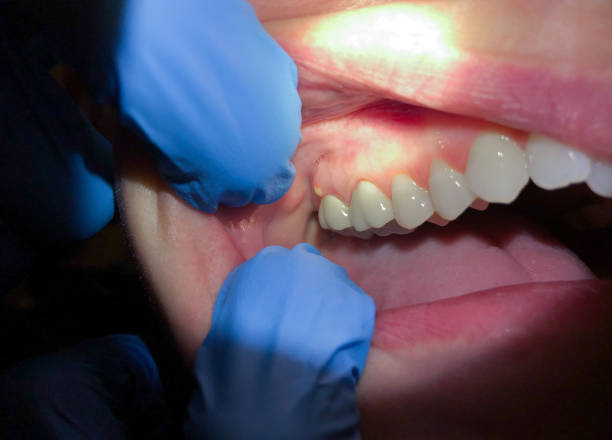 Best Emergency Broken Tooth Repair in Newton, IA